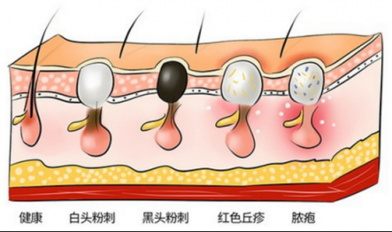 让黑头乖乖跑出来，黑头仪有用吗？