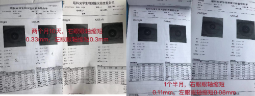 艾尔兴如何防近视？光合作用是王道，艾尔兴视力矫正里的光学原理