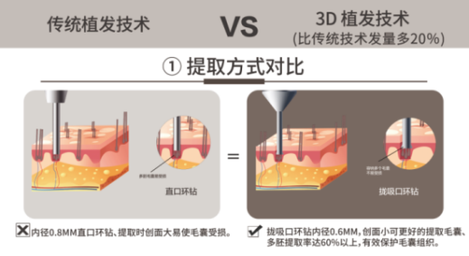 温州新生植发：3D植发技术享誉国际，受毛发领域专家赞赏
