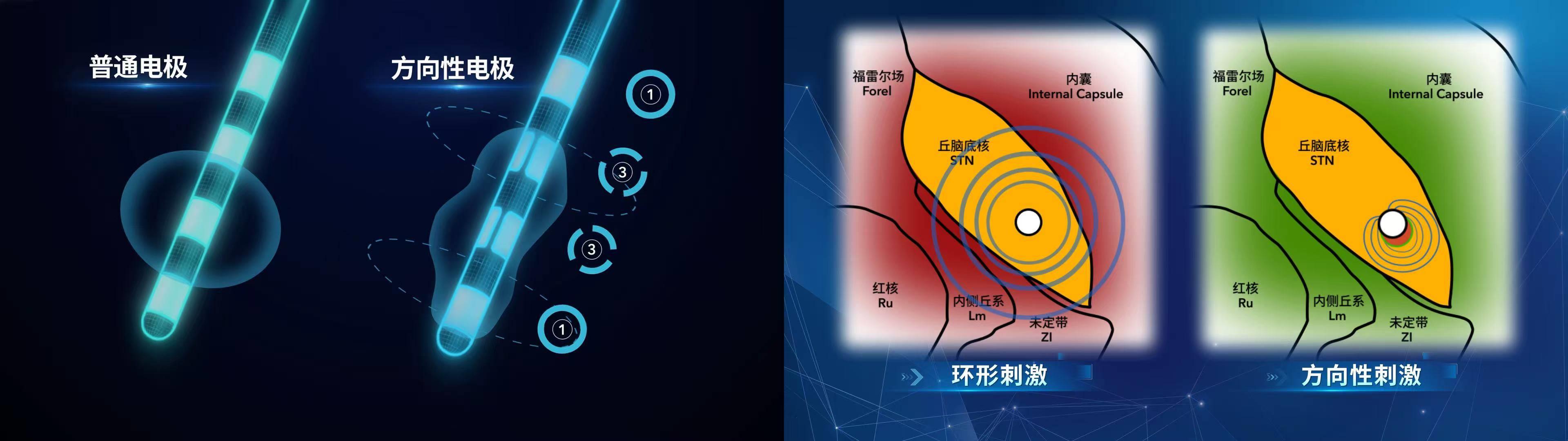 西部首例，高科技机器人辅助方向性电极植入在西安市人民医院（西安市第四医院）实施